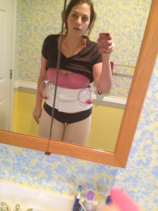 two days post-op. looking rough, but standing pretty straight!